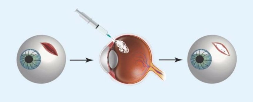 Создан инновационный клей для лечения глаз