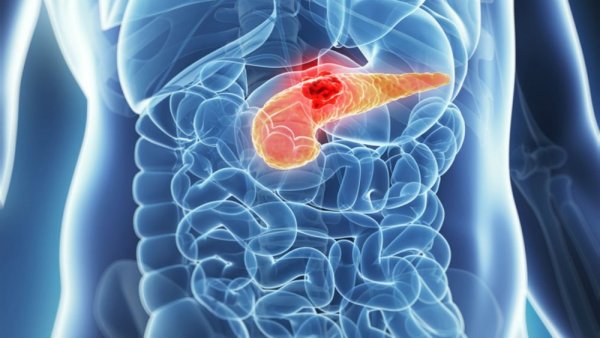 Ученые: Диабет может указывать на рак поджелудочной железы