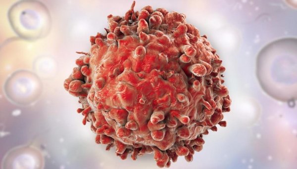 Рак Кобзона можно победить: Онкологи нашли новый способ лечения рака предстательной железы