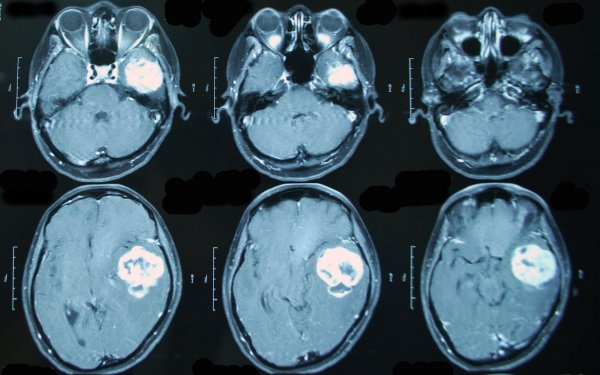 Ученые: Россияне стали чаще болеть раком мозга