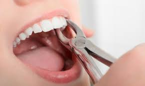 Технологии экстракции зубов у взрослого